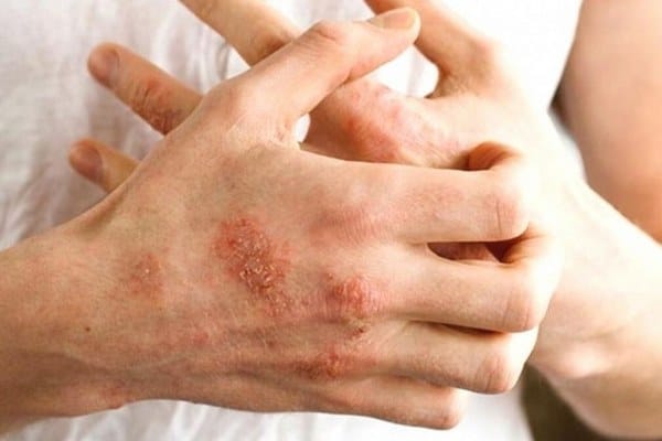 Atopik dermatit, yani egzama, Dermatoloji Uzmanı Dr. Oğuz Küçükçakır tarafından açıklanarak, bahar aylarında polen yoğunluğu nedeniyle tetiklendiği gibi, sonbaharın gelmesiyle birlikte soğuyan havalar ve düşen nem oranının etkisiyle de ortaya çıkabilir. Dr. Küçükçakır, bu durumun bazen günlük yaşamı ciddi şekilde etkileyebileceğini belirtti.