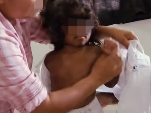 Hipertrikozis, vücutta aşırı kıl büyümesiyle karakterize nadir bir hastalıktır. Doğumda var olan ya da sonradan gelişen iki ana formda görülür. Genellikle "kurt adam sendromu" olarak bilinen bu durum, vücutta her bölgede ya da belirli alanlarda aşırı kıllanma ile kendini gösterir.